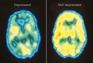 princ_rm_pet_scan_of_depressed_brain